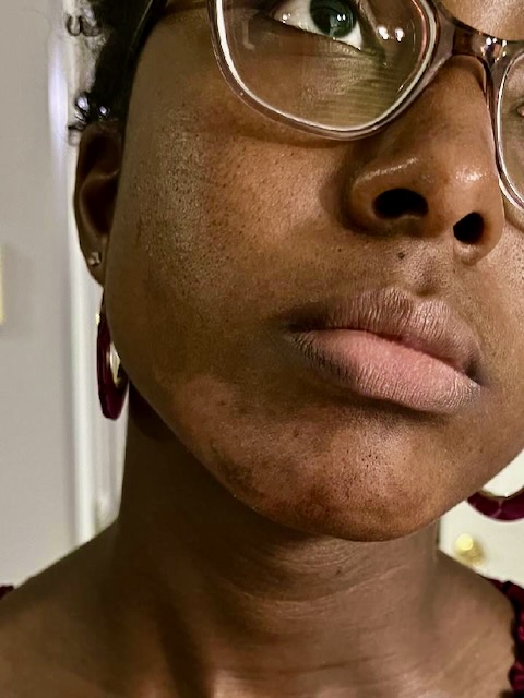 Chin after