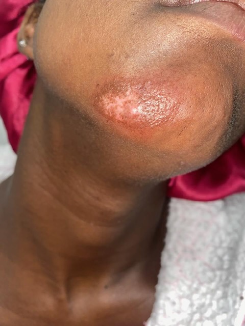 Chin before
