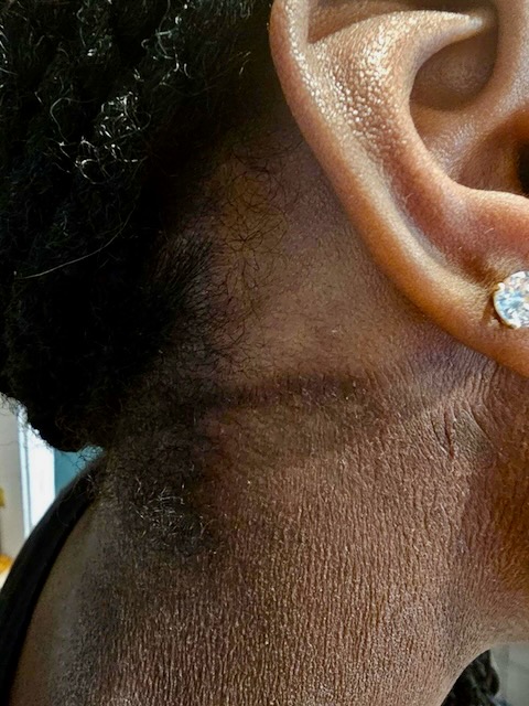 Neck after